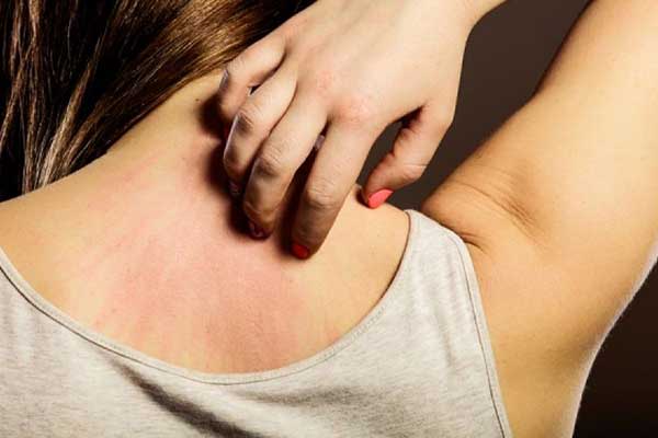 Φαγούρα: Ποιες είναι οι αιτίες και πώς αντιμετωπίζεται;