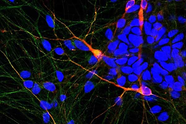 Έλληνες επιστήμονες καταπολέμησαν τη νόσο Πάρκινσον σε πειραματόζωα